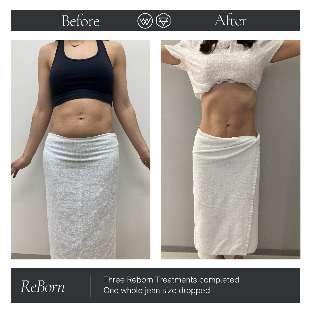 Lightfective ReBorn: the Painless Body Contouring Solution